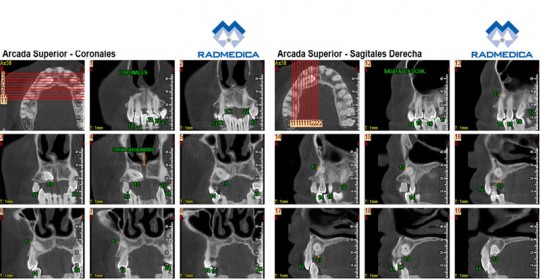 CBCT DIENTES INCLUIDOS
