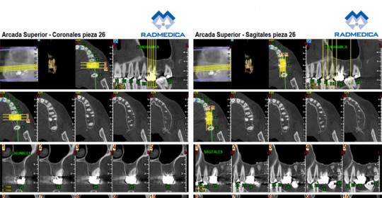 CBCT ENDODONCIA