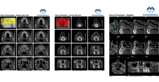 CBCT SINUS PARANASALS